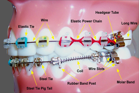 braces wire shifted to one side